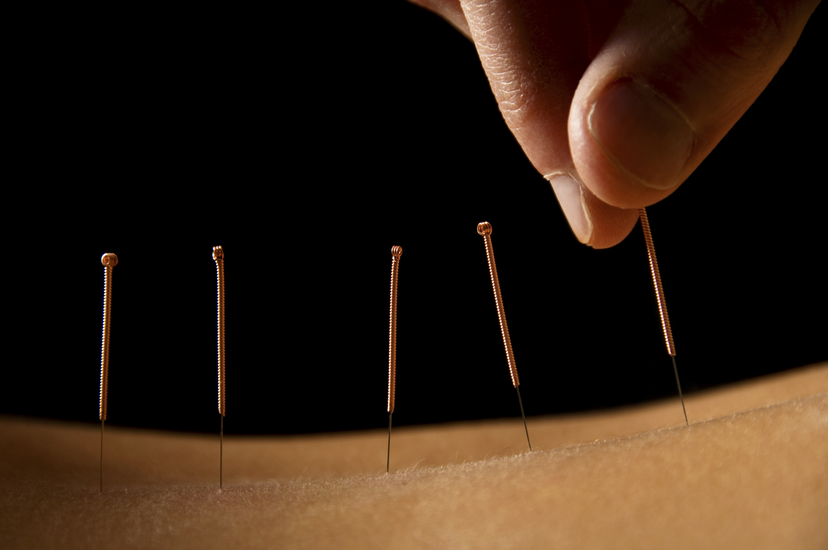 Acupuncture: An effective treatment for chronic headaches
