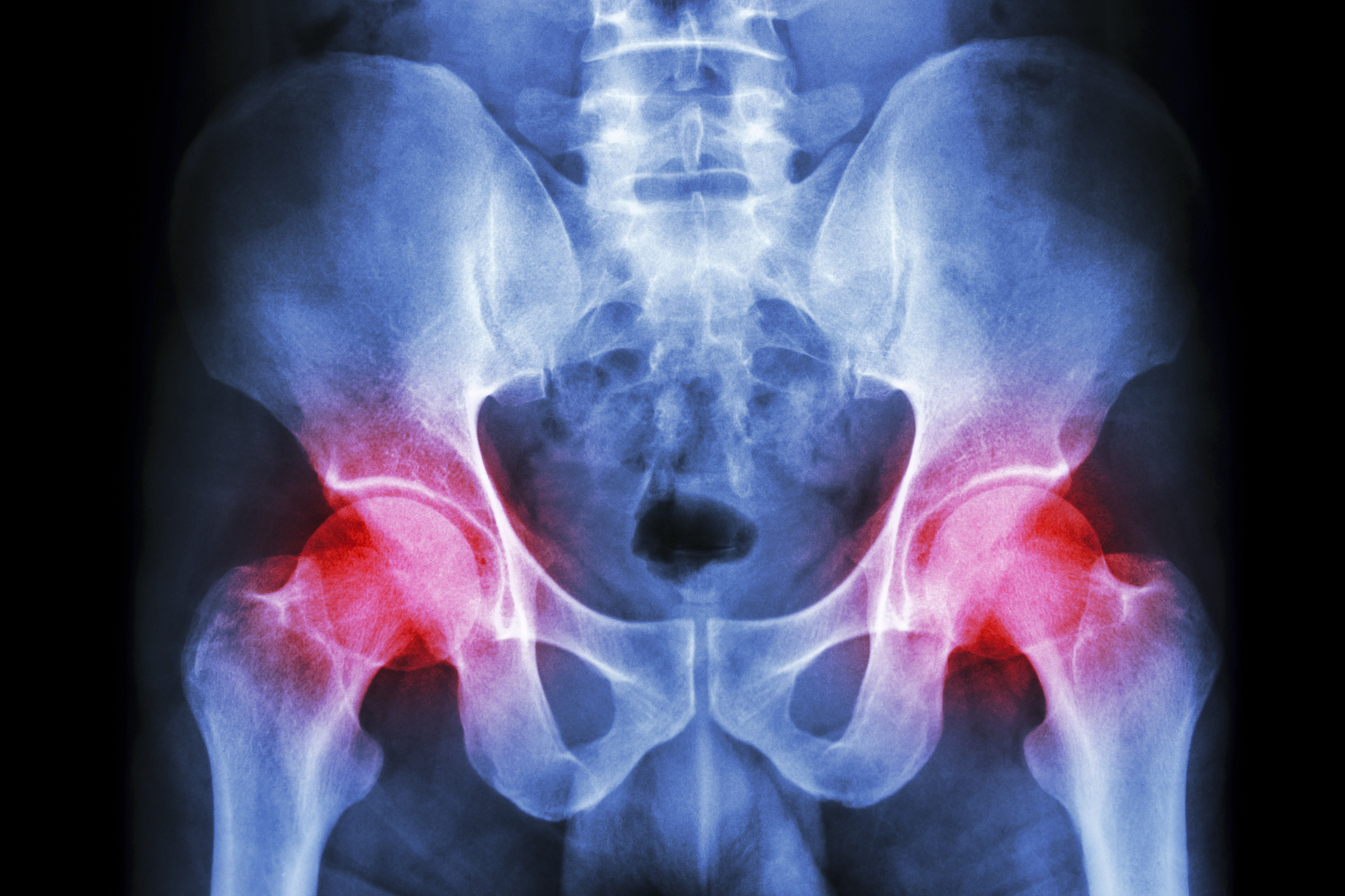 Mini-incision hip replacement surgery: Is it right for you?