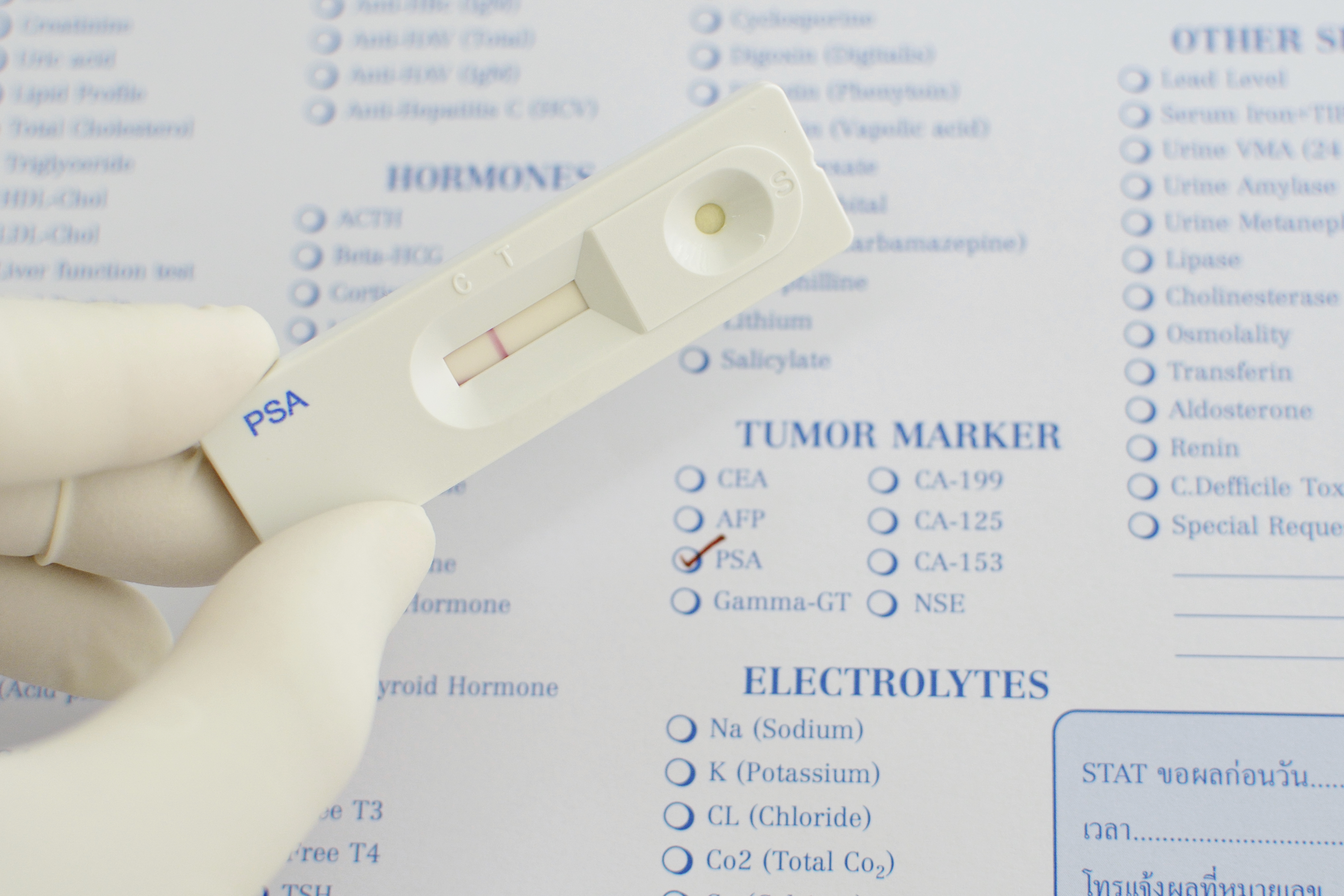 prostate tumor marker test Melyek a fibrózisok a prosztatában