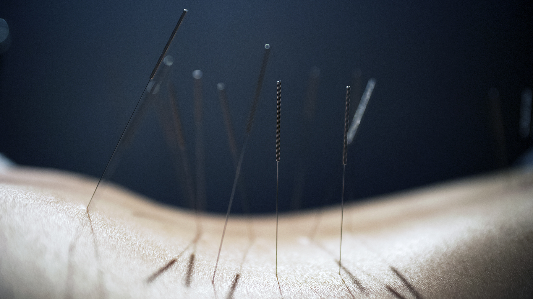 Acupuncture for joint pain Does it work?